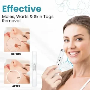 Bikenda® LUXE Non-Invasive Mole and Wart Removal Laser Pen