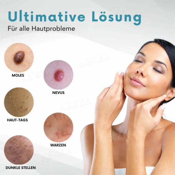 Bikenda® Nicht-invasiv Leberfleck- und Warzenentfernungs-Laserstift