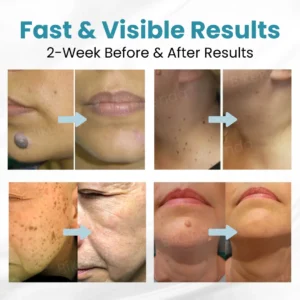 Bikenda® Non-invasive Mole and Wart Removal Laser Pen