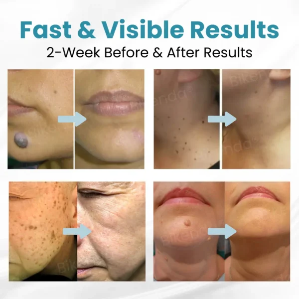 Bikenda® Non-invasive Mole and Wart Removal Laser Pen