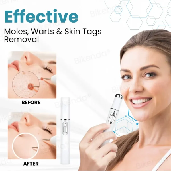 Bikenda® Non-invasive Mole and Wart Removal Laser Pen