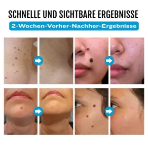 Bikenda® SpotlessDerm Molen- und Warzen-Laserstift
