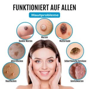 Bikenda® SpotlessDerm Molen- und Warzen-Laserstift
