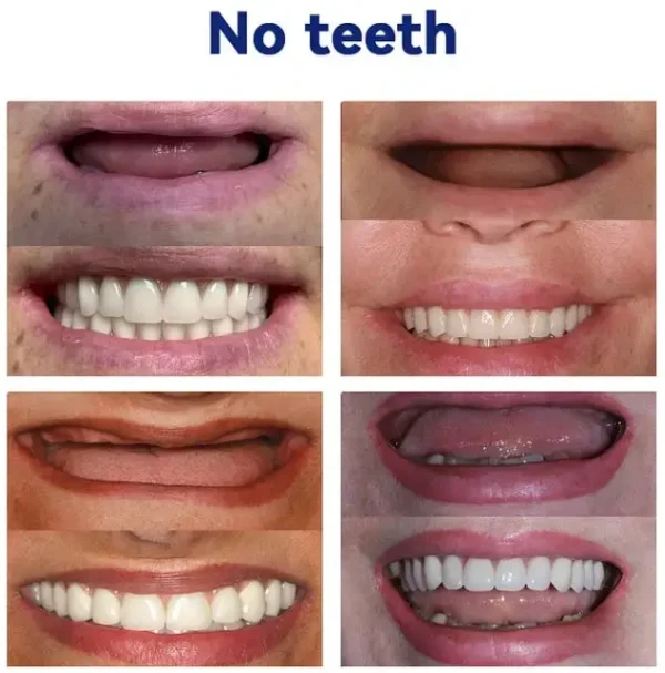Bikenda®Advanced Full Denture Set