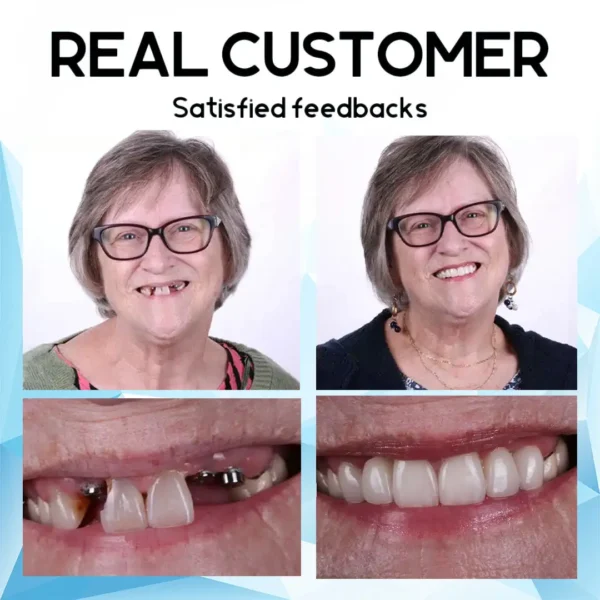 Bikenda™ Silicone Reline Denture Set(⏰Limited time discount Last 30 minutes⏰)