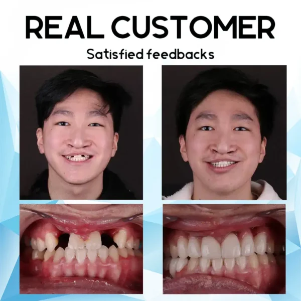 Bikenda™ Silicone Reline Denture Set(⏰Limited time discount Last 30 minutes⏰)