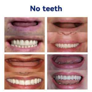 𝐵𝑖𝑘𝑒𝑛𝑑𝑎™ 𝑆𝑖𝑙𝑖𝑐𝑜𝑛𝑒 𝐷𝑒𝑛𝑡𝑢𝑟𝑒 𝑅𝑢𝑙𝑒𝑟 𝑆𝑒𝑡 (👩‍🔬👩‍🔬✅ Tested, Trusted, and Dentist-Recommended）🔥🔥