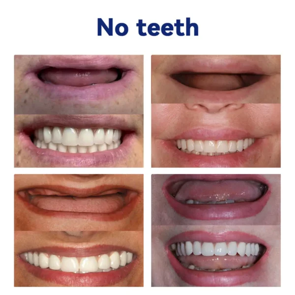 𝐵𝑖𝑘𝑒𝑛𝑑𝑎™ 𝑆𝑖𝑙𝑖𝑐𝑜𝑛𝑒 𝐷𝑒𝑛𝑡𝑢𝑟𝑒 𝑅𝑢𝑙𝑒𝑟 𝑆𝑒𝑡 (👩‍🔬👩‍🔬✅ Tested, Trusted, and Dentist-Recommended）🔥🔥