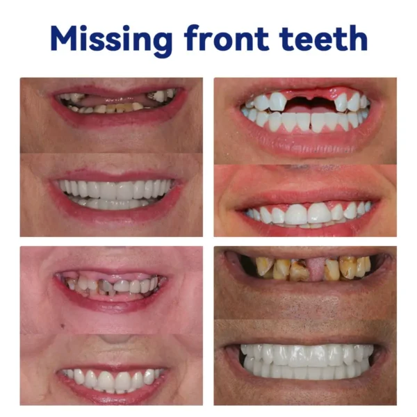 𝐵𝑖𝑘𝑒𝑛𝑑𝑎™ 𝑆𝑖𝑙𝑖𝑐𝑜𝑛𝑒 𝐷𝑒𝑛𝑡𝑢𝑟𝑒 𝑅𝑢𝑙𝑒𝑟 𝑆𝑒𝑡 (👩‍🔬👩‍🔬✅ Tested, Trusted, and Dentist-Recommended）🔥🔥