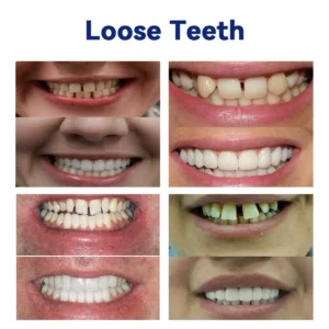𝐵𝑖𝑘𝑒𝑛𝑑𝑎™ 𝑆𝑖𝑙𝑖𝑐𝑜𝑛𝑒 𝐷𝑒𝑛𝑡𝑢𝑟𝑒 𝑅𝑢𝑙𝑒𝑟 𝑆𝑒𝑡 (👩‍🔬👩‍🔬✅ Tested, Trusted, and Dentist-Recommended）🔥🔥