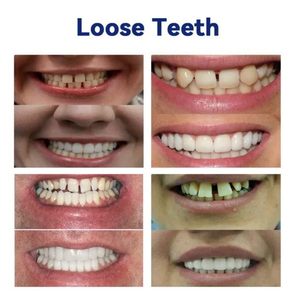 𝐵𝑖𝑘𝑒𝑛𝑑𝑎™ 𝑆𝑖𝑙𝑖𝑐𝑜𝑛𝑒 𝐷𝑒𝑛𝑡𝑢𝑟𝑒 𝑅𝑢𝑙𝑒𝑟 𝑆𝑒𝑡 (👩‍🔬👩‍🔬✅ Tested, Trusted, and Dentist-Recommended）🔥🔥