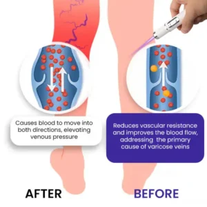 🌟 Official Store | Bikenda® Varicose Vein Photothermal Laser Treatment🔥Say Goodbye to Varicose Veins and Hello to Confidence!