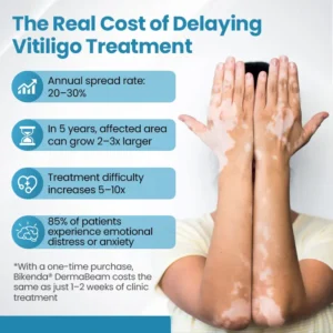Bikenda® DermaBeam Vitiligo Therapy Device ✅3-5 Second Vitiligo Treatment, Visible Results in Just 2 Weeks