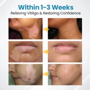 Bikenda® DermaBeam Vitiligo Therapy Device ✅3-5 Second Vitiligo Treatment, Visible Results in Just 2 Weeks