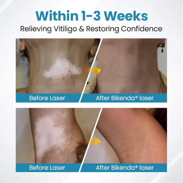 Bikenda® DermaBeam Vitiligo Therapy Device ✅3-5 Second Vitiligo Treatment, Visible Results in Just 2 Weeks