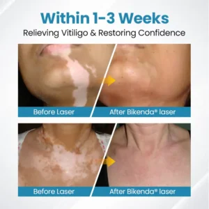 Bikenda® DermaBeam Vitiligo Therapy Device ✅3-5 Second Vitiligo Treatment, Visible Results in Just 2 Weeks