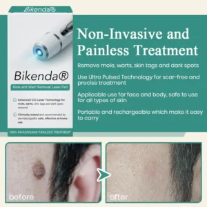 Bikenda® Mole and Wart Instant Removal Laser Pen