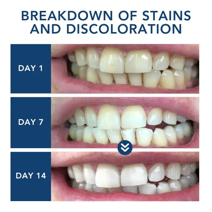 Bikenda® Laser Smile Care Device — Bright Smile · Gum Health · Daily Care