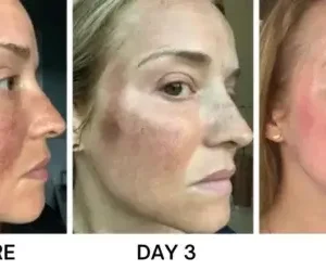 Bikenda® Portable Skin Care Laser Pen