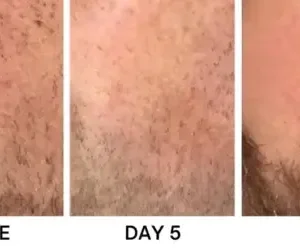 Bikenda® Portable Skin Care Laser Pen