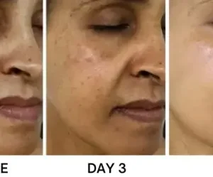 Bikenda® Portable Skin Care Laser Pen