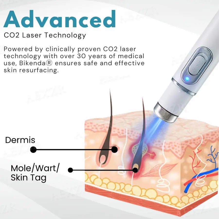 Bikenda® PRO Non-Invasive Mole and Wart Removal Laser Pen